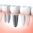 Dental Implants in Iran - dentistry in Iran