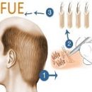 FUE-Follicular-Unit-Extraction-in-Iran